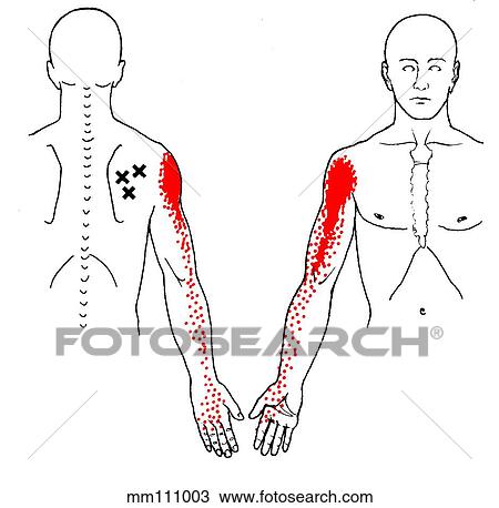 Infraspinatus m., trigger points View Large Illustration Drawing - Infraspinatus m., trigger points. Fotosearch