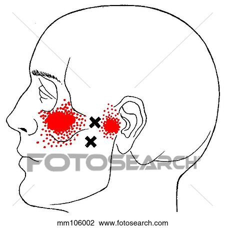 Lateral pterygoid m., trigger points View Large Illustration Drawing - Lateral pterygoid m., trigger points. Fotosearch