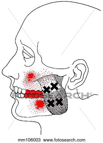 Masseter m., trigger points View Large Illustration Drawing - Masseter m., trigger points. Fotosearch