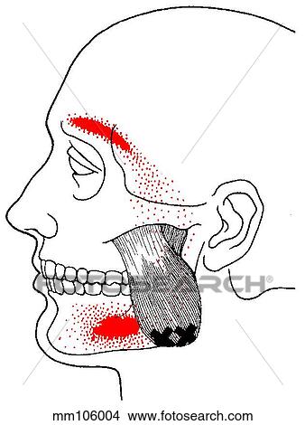 Masseter m., trigger points View Large Illustration Stock Illustration - Masseter m., trigger points. Fotosearch
