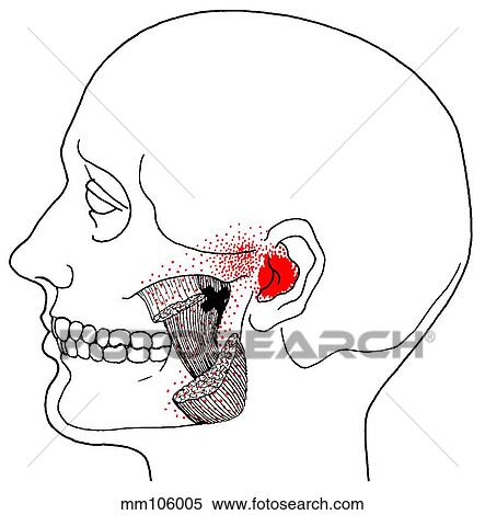 Masseter m., trigger points View Large Illustration Stock Illustration - Masseter m., trigger points. Fotosearch
