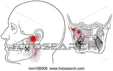 Medial pterygoid m., trigger points View Large Illustration Stock Illustration - Medial pterygoid m., trigger points. Fotosearch
