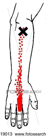 Drawing - Middle finger extensor m., trigger points. Fotosearch