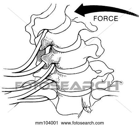 Nerve root compression View Large Illustration Clip Art - Nerve root compression. Fotosearch