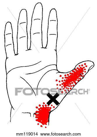 Opponens pollicis m., trigger points View Large Illustration Stock Illustration - Opponens pollicis m., trigger points. Fotosearch