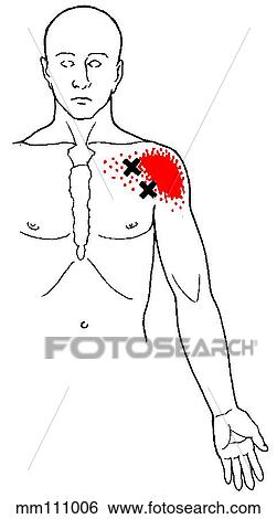 Stock Illustration - Pectoralis major m., trigger points. Fotosearch