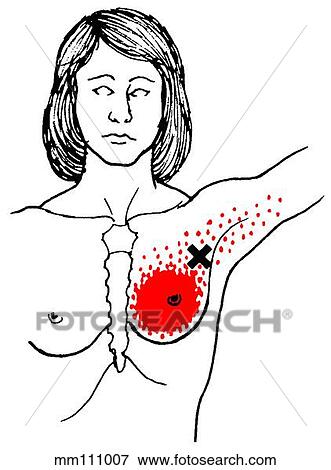 Pectoralis major m., trigger points View Large Illustration Stock Illustration - Pectoralis major m., trigger points. Fotosearch