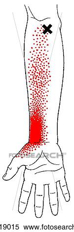 Pronator teres m., trigger points View Large Illustration Stock Illustration - Pronator teres m., trigger points. Fotosearch