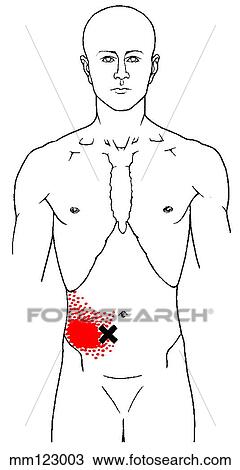 Drawing - Rectus abdominus m., trigger points. Fotosearch