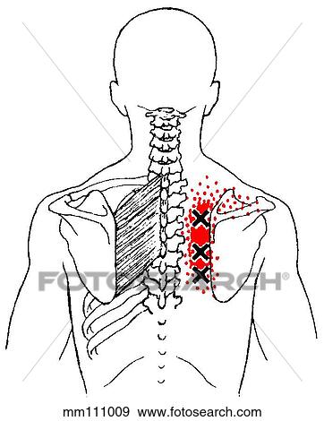 Rhomboid m., trigger points View Large Illustration Stock Illustration - Rhomboid m., trigger points. Fotosearch