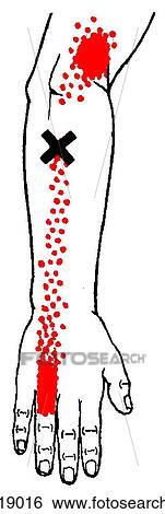 Ring finger extensor m., trigger points View Large Illustration Stock Illustration - Ring finger extensor m., trigger points. Fotosearch