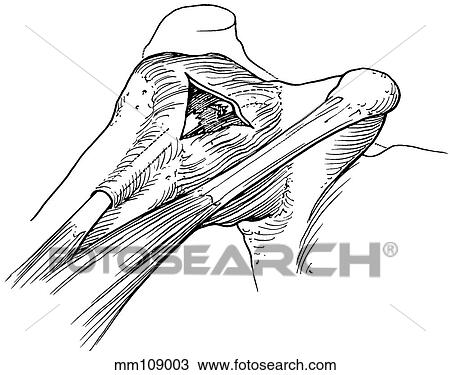 Drawing - Rotator cuff, biceps tendon tears. Fotosearch