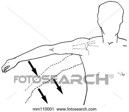 Clip Art - Rotator cuff, drop arm test. Fotosearch