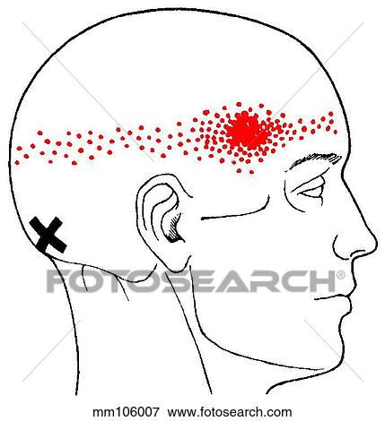 Semispinalis capitis m., trigger points View Large Illustration Stock Illustration - Semispinalis capitis m., trigger points. Fotosearch