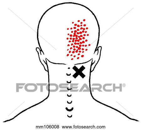 Semispinalis cervicis m., trigger points View Large Illustration Stock Illustration - Semispinalis cervicis m., trigger points. Fotosearch