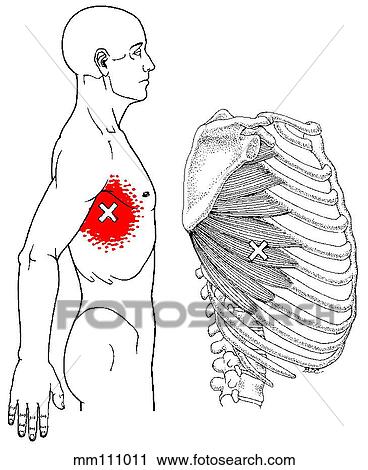 Clip Art - Serratus anterior m., trigger points. Fotosearch