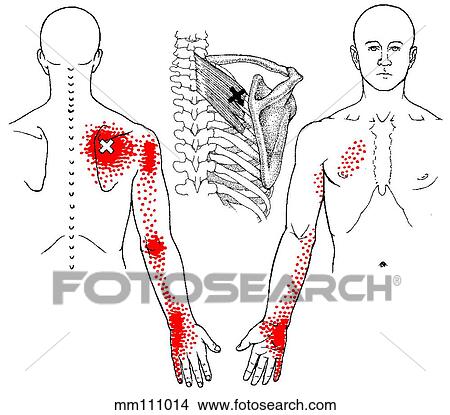 Stock Illustration - Serratus posterior sup. m., trigger points. Fotosearch