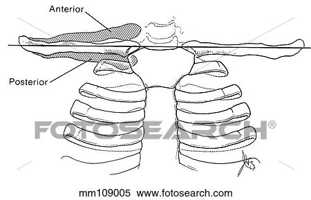 Shoulder, anterior dislocation View Large Illustration Stock Illustration - Shoulder, anterior dislocation. Fotosearch