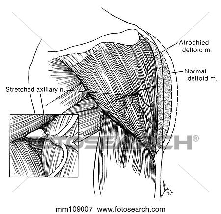 Stock Illustration - Shoulder, axillary nerve compression. Fotosearch