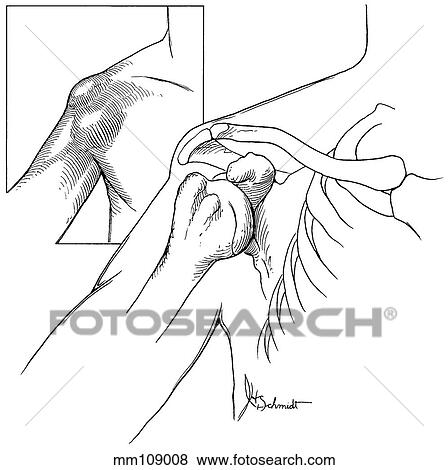 Shoulder, dislocation View Large Illustration Stock Illustration - Shoulder, dislocation. Fotosearch