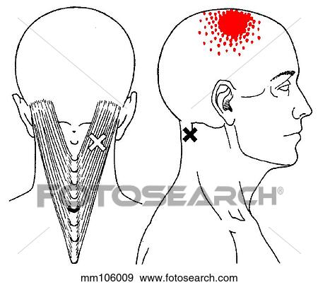 Splenius capitis m., trigger points View Large Illustration Stock Illustration - Splenius capitis m., trigger points. Fotosearch