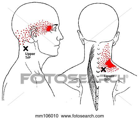 Splenius Cervicis M Trigger Points Clipart Mm106010 Fotosearch