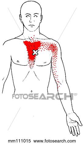 Sternalis m., trigger points View Large Illustration Stock Illustration - Sternalis m., trigger points. Fotosearch
