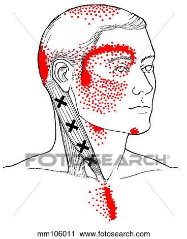 Sternocleidomastoid m., trigger points View Large Illustration Clip Art - Sternocleidomastoid m., trigger points. Fotosearch