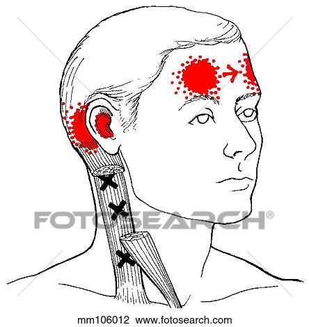 Sternocleidomastoid m., trigger points View Large Illustration Drawing - Sternocleidomastoid m., trigger points. Fotosearch