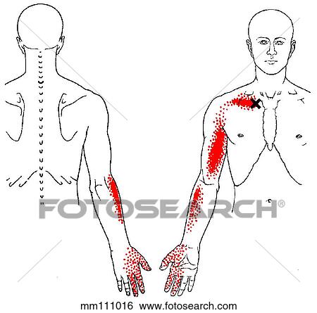 Subclavius m., trigger points View Large Illustration Stock Illustration - Subclavius m., trigger points. Fotosearch
