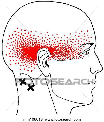 Suboccipital m., trigger points View Large Illustration Drawing - Suboccipital m., trigger points. Fotosearch