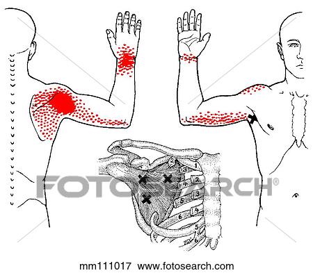 Stock Illustration - Subscapularis m., trigger points. Fotosearch