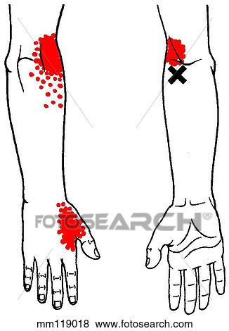 Supinator m., trigger points View Large Illustration Stock Illustration - Supinator m., trigger points. Fotosearch
