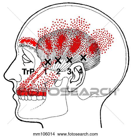 Temporalis m., trigger points View Large Illustration Stock Illustration - Temporalis m., trigger points. Fotosearch