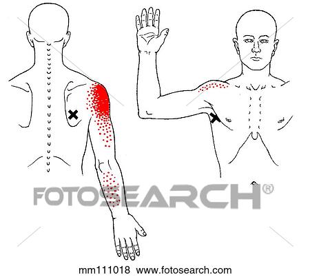 Teres major m., trigger points Stock Illustration | mm111018 | Fotosearch