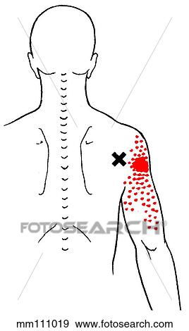 Teres minor m., trigger points Stock Illustration | mm111019 | Fotosearch