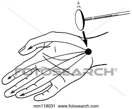 Clip Art - Tinel's sign. Fotosearch