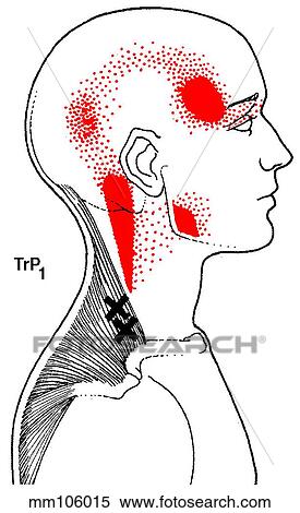 Trapezius m., trigger points View Large Illustration Stock Illustration - Trapezius m., trigger points. Fotosearch
