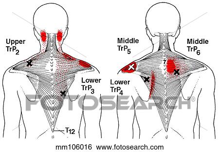 Trapezius m., trigger points View Large Illustration Stock Illustration - Trapezius m., trigger points. Fotosearch