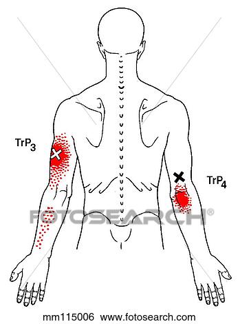 Triceps brachii m., trigger points View Large Illustration Stock Illustration - Triceps brachii m., trigger points. Fotosearch