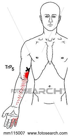 Stock Illustration - Triceps brachii m., trigger points. Fotosearch