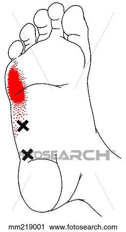 Clip Art - Abductor digiti minimi m., trigger points. Fotosearch