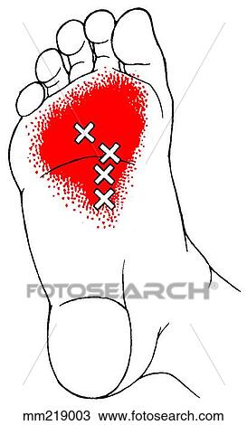 Drawing - Adductor hallucis m., trigger points. Fotosearch