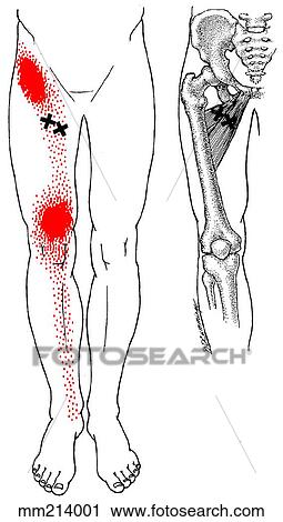 Adductor longus/adductor brevis m., trigger points View Large Illustration Clip Art - Adductor longus/adductor brevis m., trigger points. Fotosearch