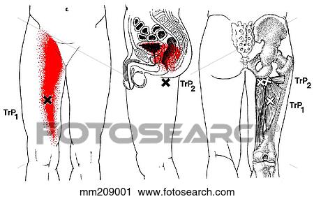 Adductor magnus m., trigger points View Large Illustration Clip Art - Adductor magnus m., trigger points. Fotosearch
