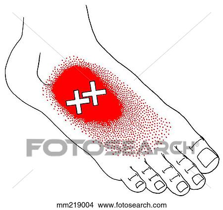 Extensor digitorum brevis m., trigger points View Large Illustration Stock Illustration - Extensor digitorum brevis m., trigger points. Fotosearch