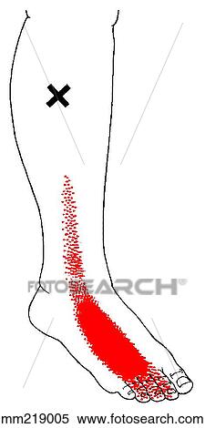 Extensor digitorum longus m., trigger points View Large Illustration Stock Illustration - Extensor digitorum longus m., trigger points. Fotosearch