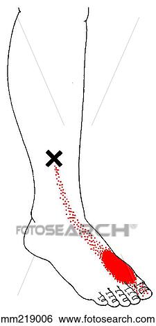 Extensor hallucis longus m., trigger points View Large Illustration Stock Illustration - Extensor hallucis longus m., trigger points. Fotosearch