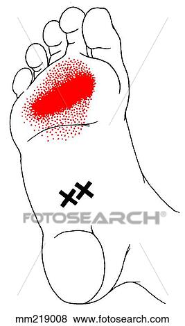 Flexor digitorum brevis m., trigger points View Large Illustration Stock Illustration - Flexor digitorum brevis m., trigger points. Fotosearch