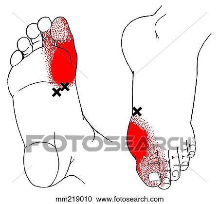 Clipart - Flexor hallucis brevis m., trigger points. Fotosearch